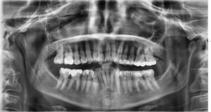 dental x-ray teeth alignment