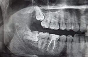 an x-ray showing impacted wisdom teeth